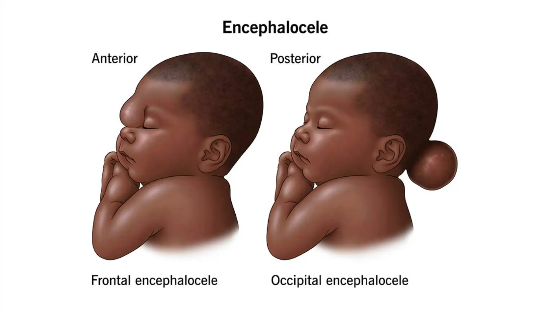 Encefalocele: o que é e possibilidades de tratamento cirúrgico