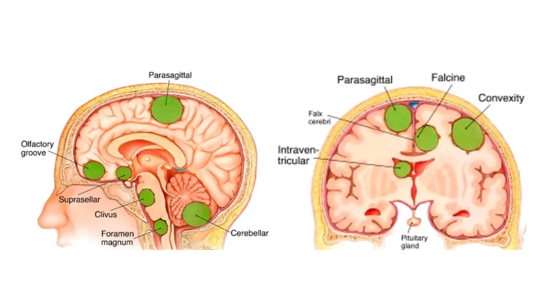 Meningiomas