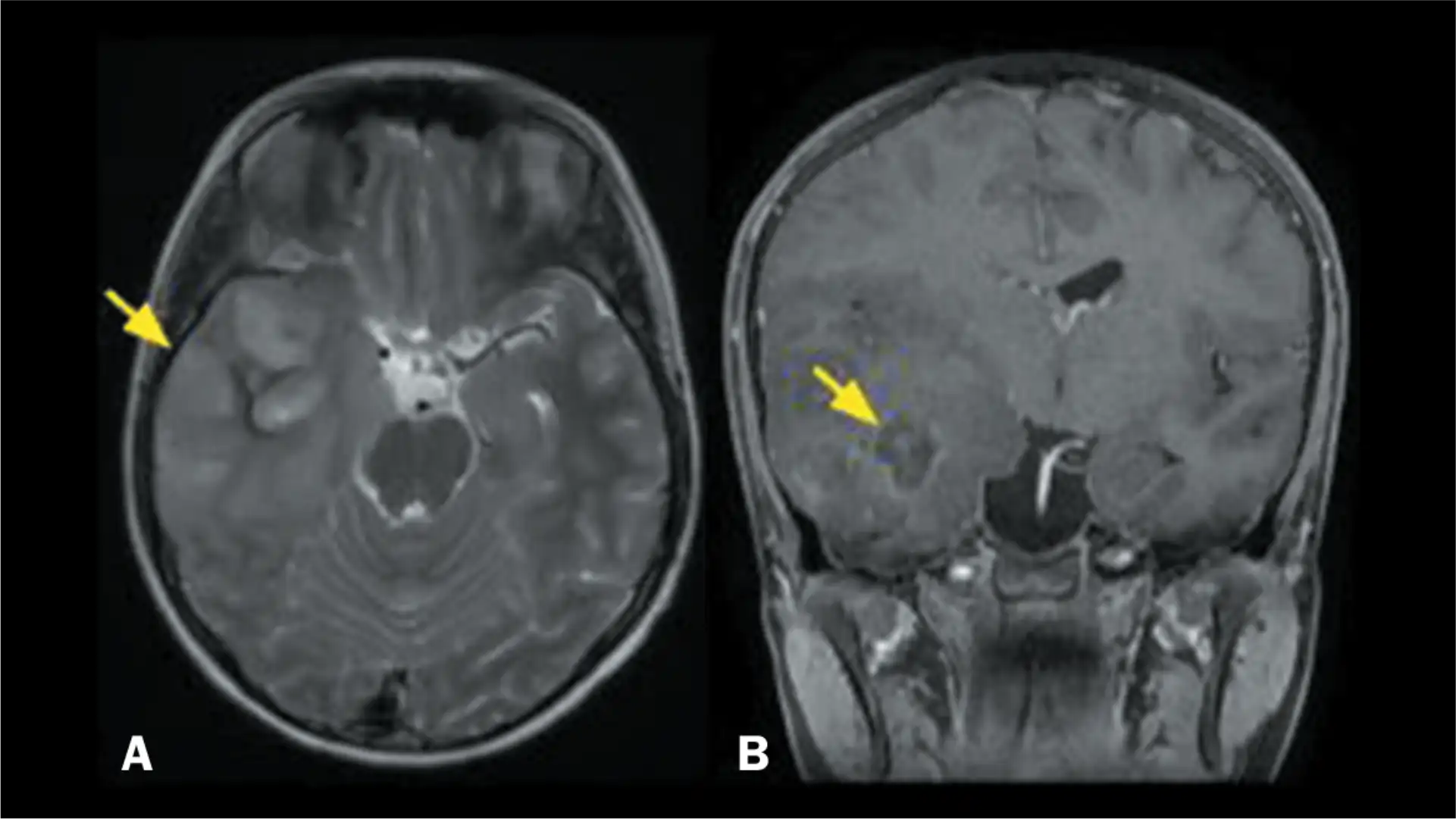 Gliomas de Baixo Grau