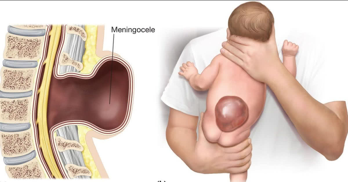 Diagnóstico de Mielomeningocele: Entendendo a jornada do seu bebê